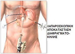 Γαστροοισοφαγική παλινδρόμηση